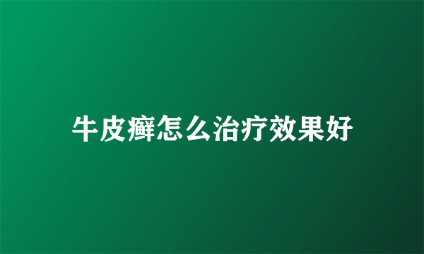 牛皮癣怎么治疗效果好