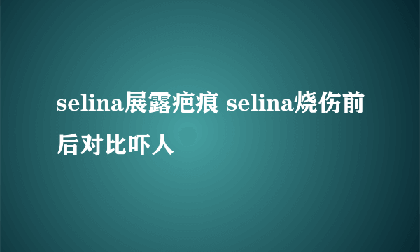 selina展露疤痕 selina烧伤前后对比吓人