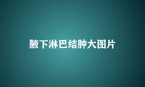 腋下淋巴结肿大图片